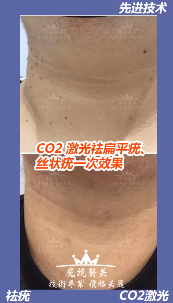 祛疣 多伦多 1