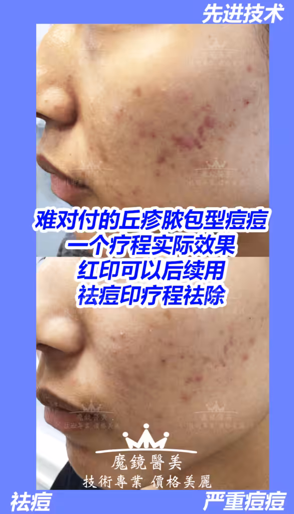 多伦多 祛痘疤 3