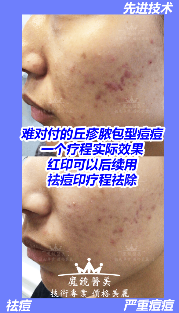 多伦多 祛痘疤 3
