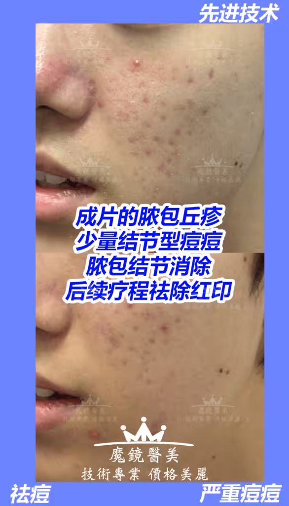 多伦多 祛痘疤 2