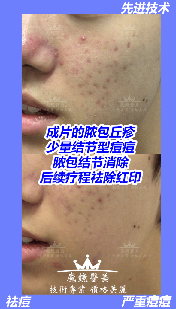 多伦多 祛痘疤 2