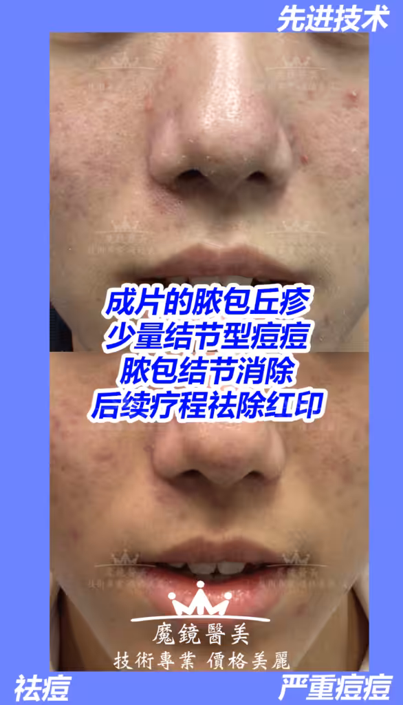 多伦多 祛痘疤 1
