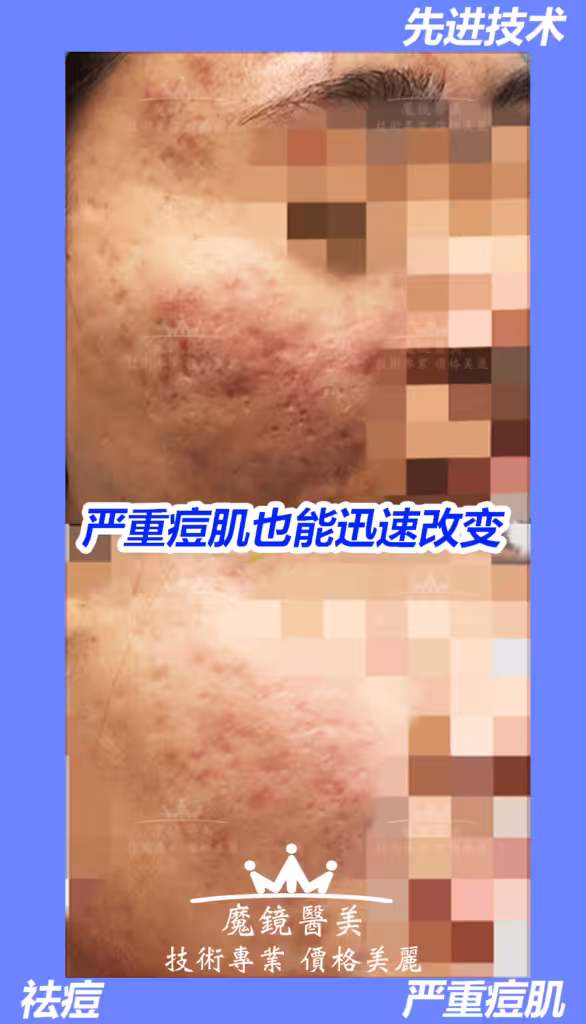 医美 祛痘