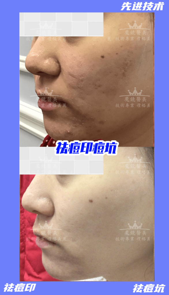 痘坑治疗