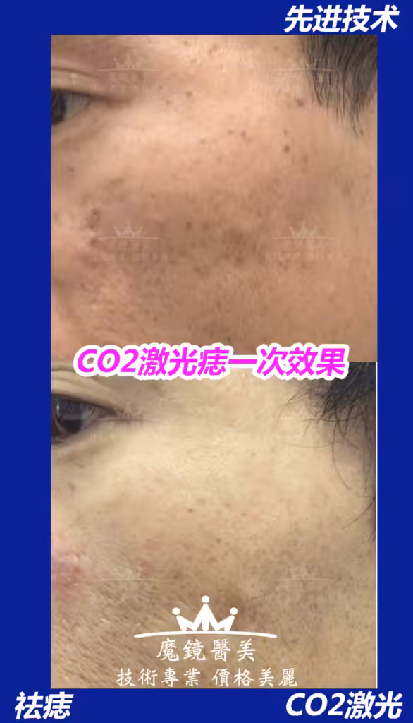 祛疣 多伦多 5